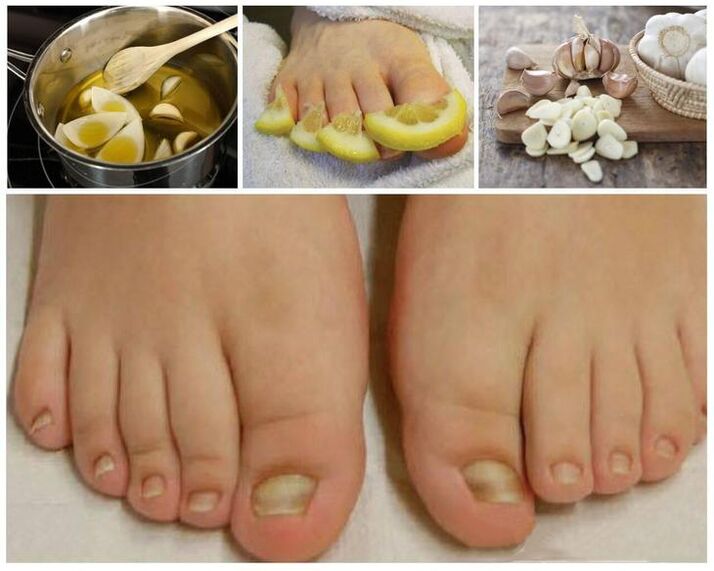 Nagelpilz