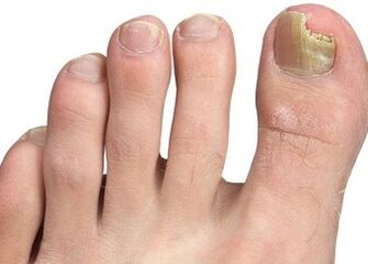 Symptome von Nagelpilz