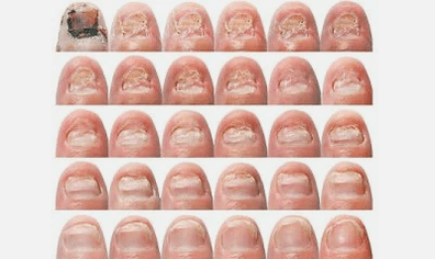 Wie sieht der Nagelpilz aus